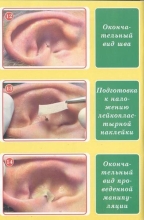 прошивание ушной раковины